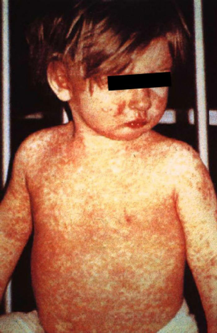 A child with measles exhibits the characteristic rash associated with the disease | Photo Credit: Centers for Disease Control and Prevention (CDC)/Barbara Rice