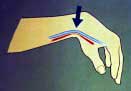 Bent Wrist