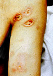 Arc burns from electricity arcing through the air and entering a man's body at his armpits