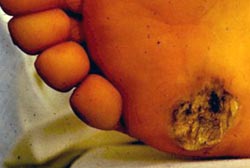 Exit wound seen on the bottom of a foot where electric current exited the body