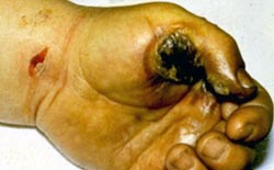 Entrance wound and thermal burns to a worker's hand caused by electrical shock from an overheated tool he was using